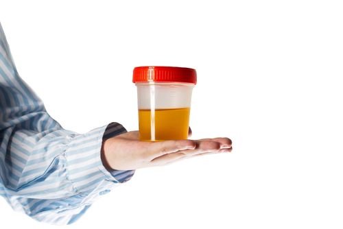 Mörk urin: Vad betyder färgen för din hälsa och njurfunktion?